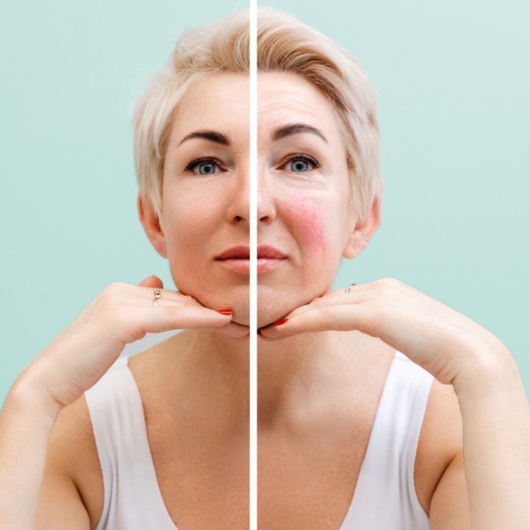 Productos para rosacea
