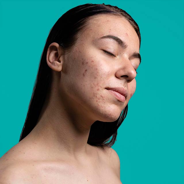 Rutina anti acné
